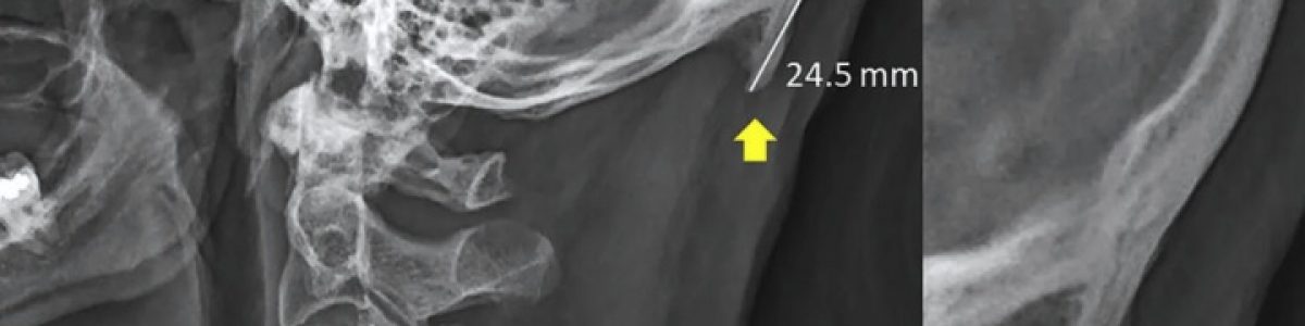 Como é que o uso de smartphone está a mudar o esqueleto humano?
